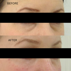 eye troughs dermal filler before and after